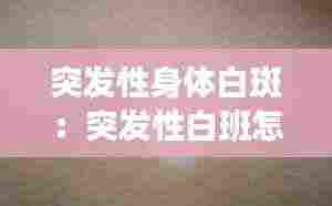 突发性身体白斑:突发性白班怎么治疗